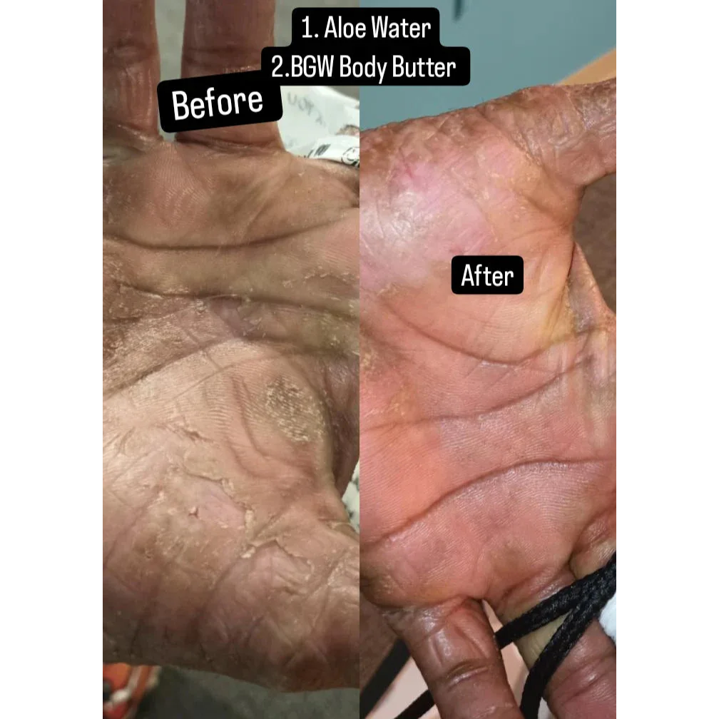 Before and after comparison of hands showing eczema relief with organic BGW Body Butter and Aloe Water application. - BlackGold Works - Dark spot corrector, Dry skin relief, Eczema, Lotion butter, Natural collagen, Natural lotion/butter, Natural moisturizer, Natural products, Natural sunscreen, Scar tissue, SKIN CARE, Skin moisturizer - Eczema Essentials Skin Repair Kit UNSCENTED