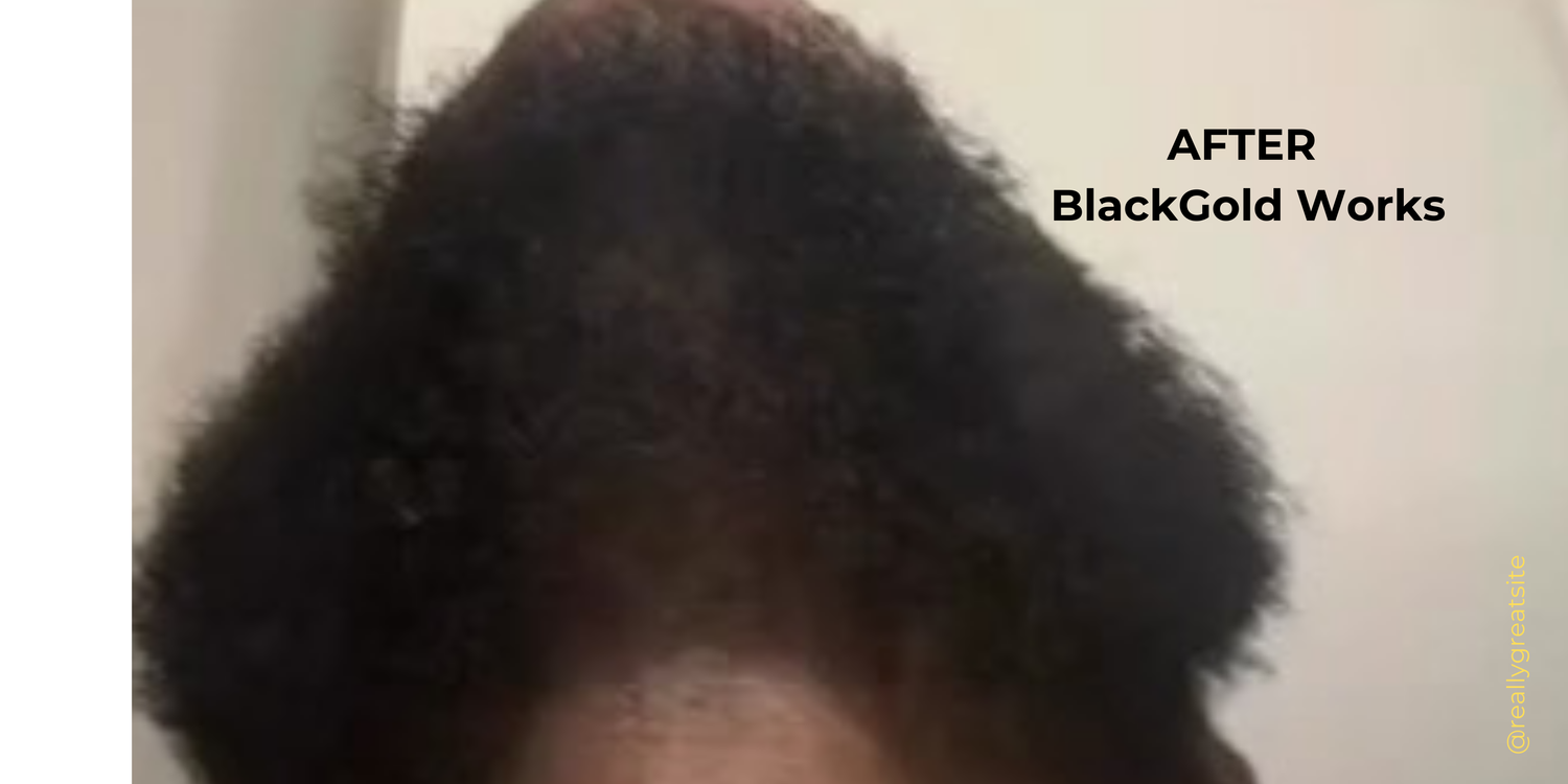 Close-up of natural black hair showing thick growth after using organic eczema-friendly hair care product. - BlackGold Works - 4c moisturizer, beard butter, beard growth, Burn cream, Burns, Cracked feet, Cracked skin, Dandruff, Dandruff relief, Dandruff treatment, Hair butter, HAIR CARE, hair growth, Hair moisturizer, Hyaluronic Acid, Natural moisturizer, Natural products, Tallow - Silk Hair/Beard Growth Kit
